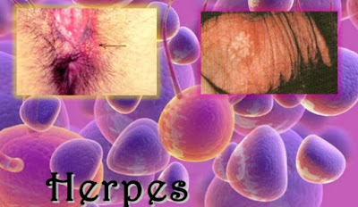 Cara Alami Untuk Mengobati Herpes