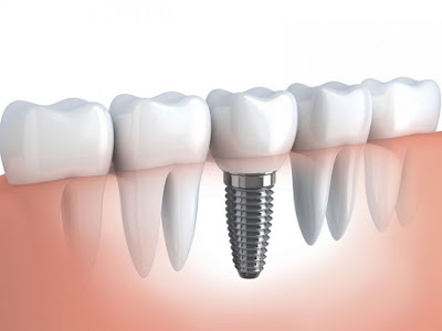  Cấy ghép Implant nha khoa ở đâu?