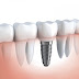  Cấy ghép Implant nha khoa ở đâu?