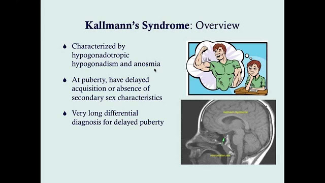 History for Kallmann syndrome