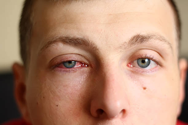 Viral Conjunctivitis: Symptoms, Treatments, and Prevention
