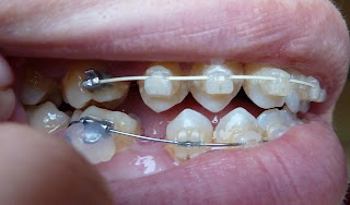 A side on photograph of teeth with fixed ceramic braces at week 17 of treatment