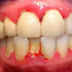 Tác hại của vôi răng 