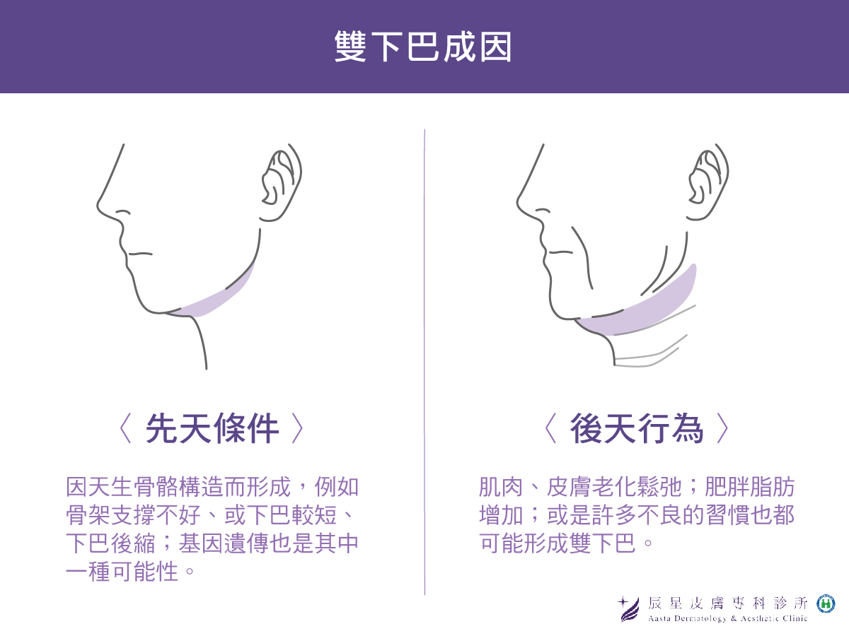 雙下巴成因