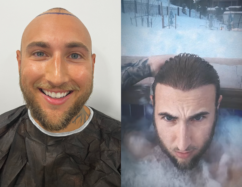 The Hair Transplant: Turkey Hair Center