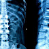 Spinal fusion