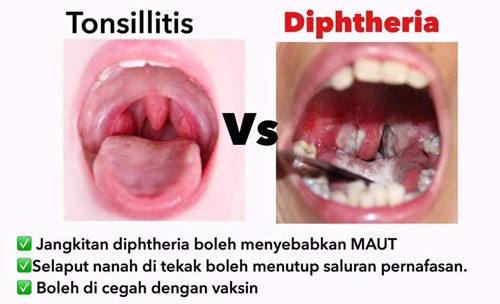 perbezaan jangkitan tonsil dan jangkitan kuman difteria, beza antara tonsillitis dan diphtheria, tanda-tanda, gejala, simptom tonsil dan difteria, perbezaan kesan sakit tonsil dan difteria terhadap kanak-kanak, beza cara merawat tonsil dan difteria