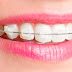 Có nên niềng răng cho 1 hàm không?
