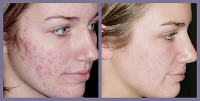 Treatment-of-acne-scars