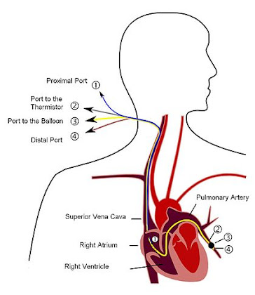 Swan-Ganz導管 Swan-Ganz catheter