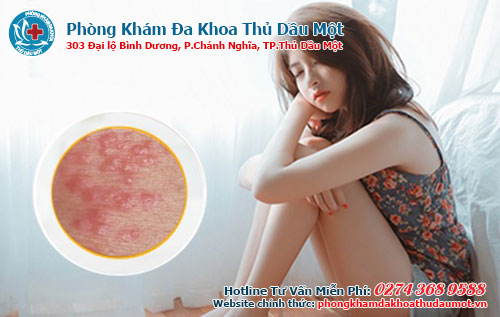 Nổi mụn thịt khu vực kín nên đến bệnh viện da liễu uy tín 