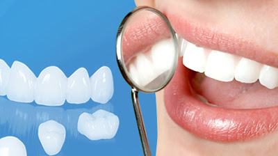 Những lợi ích khi bọc răng sứ