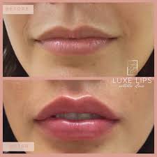 Russian Lip Technique for Lip Augmentation