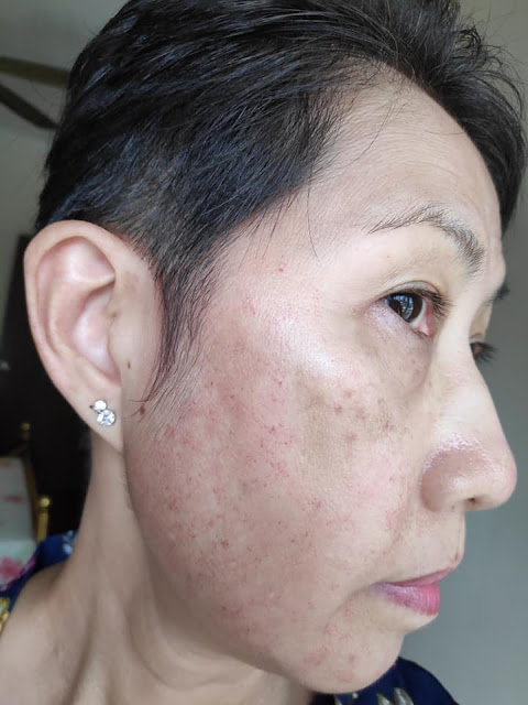 PICOCARE Laser Treatment At LUNA CLINIC Kota Damansara