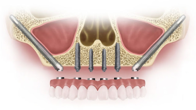 Due impianti dentali zigomatici e quattro normali e supportano la dentiera nella mascella superiore, immagine grafica
