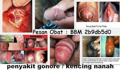 Obat Sipilis Dari Nature 