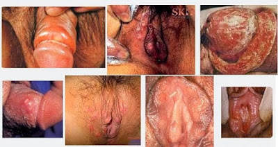 Obat Sipilis pada Wanita Paling Ampuh