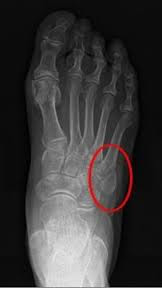 En la imagen observamos una radiografía de pie donde se muestra rodeada la zona de la fractura del quinto metatarsiano