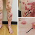 هل تعلم ما هو إلتهاب الاوعية الدموية المناعي (Vasculitis) وأي جزء من الجسم يصيب؟ هل تعلم ما هو إلتهاب الاوعية الدموية المناعي (Vasculitis) وأي جزء من الجسم يصيب؟