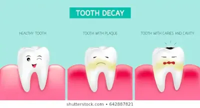 tooth-decay-formation