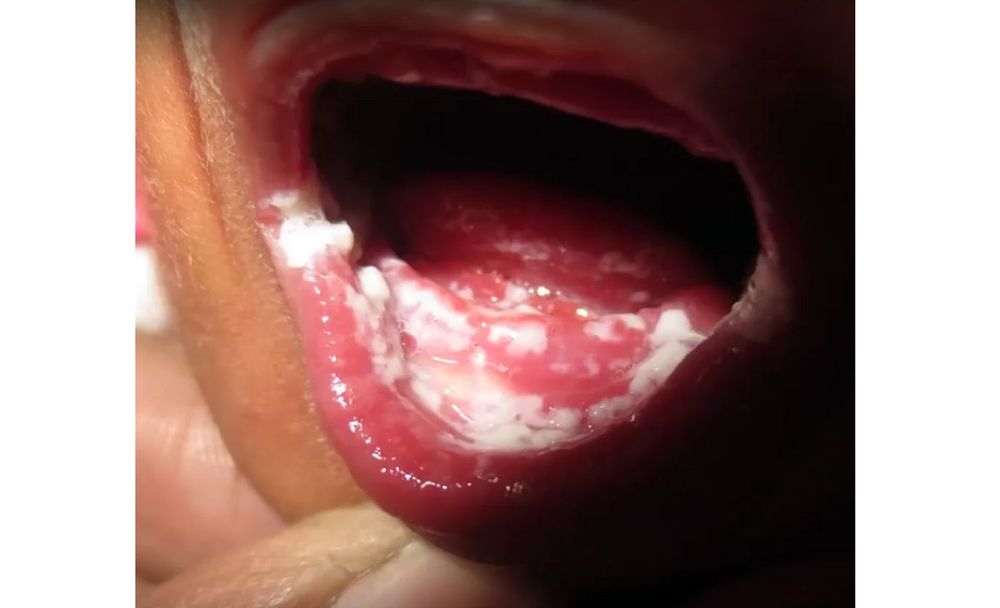 Oral Thrush