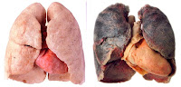 Healthy Lungs vs Smokers Lungs Photos | Quitting smoking tips