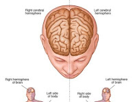 Cara Mengatasi Penyakit Stroke Secara Alami