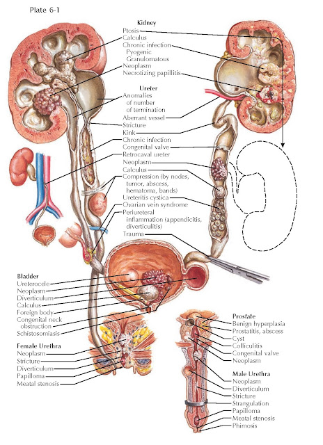 ETIOLOGY OF OBSTRUCTIVE UROPATHY