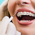 Niềng răng hoàn tất quy trình mất bao lâu?