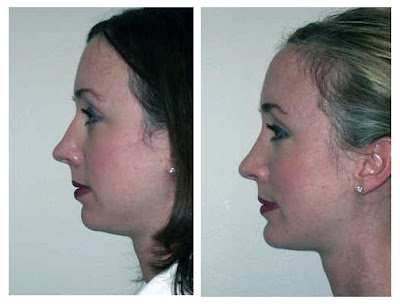 Chin Augmentation Photos