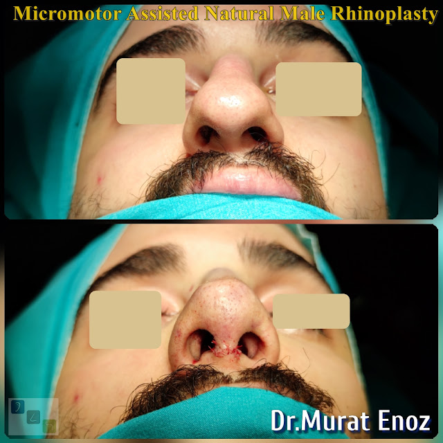 crooked nose job, twisted nose aesthetic,Asymmetric nose operation,Rhinoplasty For Men Istanbul,Micro-Motor Assisted Rhinoplasty Operation Istanbul,