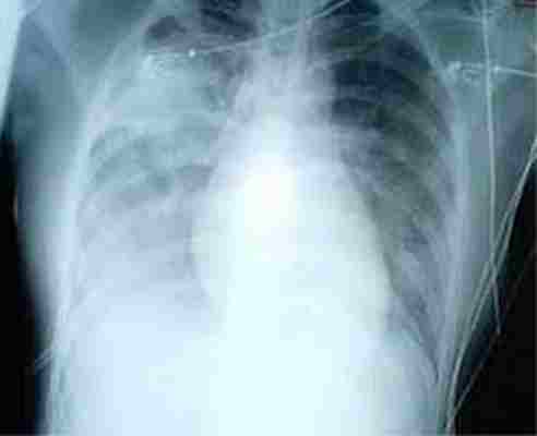 InfoGripe aponta tendência de aumento de casos de Síndrome Respiratória Aguda Grave (SRAG)