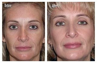 Microdermabrasion Before And After