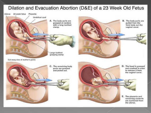 A medical abortion at 6 weeks of pregnancy