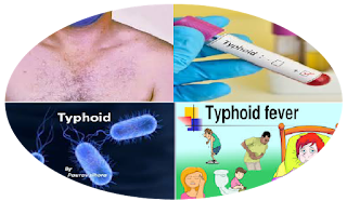  Typhoid is very dangers