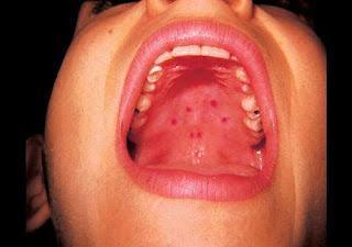 Sores on the patient's roof of the mouth pics
