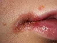 angular cheilitis treatment