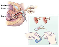 Tes Pap Smear