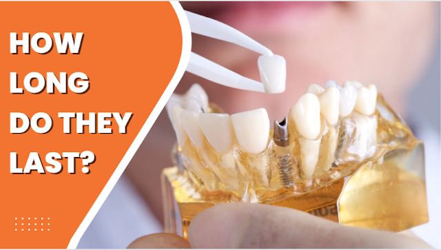 dental implants life