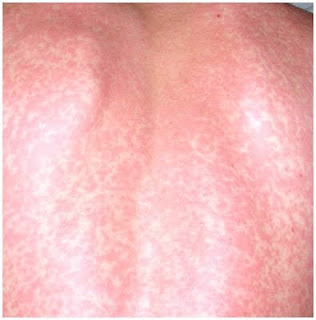 dermatitis caused by vitamin B12 deficiency