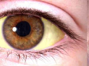 Como quitar lo amarillo de los ojos naturalmente