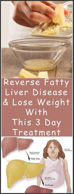 Reverse Fatty Liver Disease And Lose Weight With This 3 Day Treatment