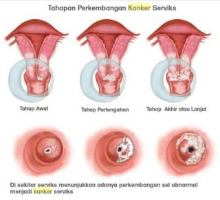 Pengobatan Penderita Kanker secara Tradisional, Cara Ampuh Untuk Mencegah Kanker Serviks, Cara Mencegah Kanker Serviks