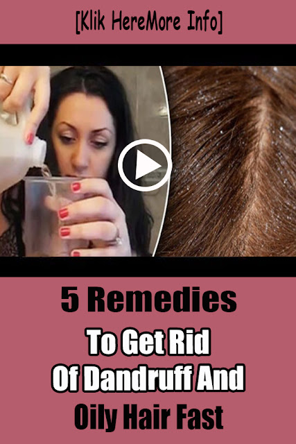 5 Remedies To Get Rid Of Dandruff And Oily Hair Fast