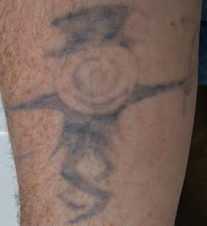 Tattoo fading after two years of Picosure