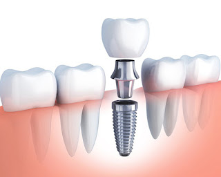 Sự khác biệt giữa các loại trụ implant-3