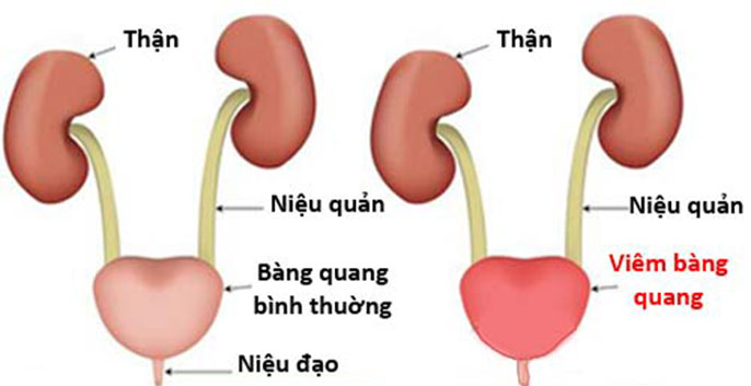 Tác động của viêm bàng quang đến sức khỏe nam giới