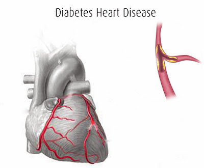 HearT Disease Template