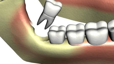 Xử lý răng khôn hàm trên mọc lệch