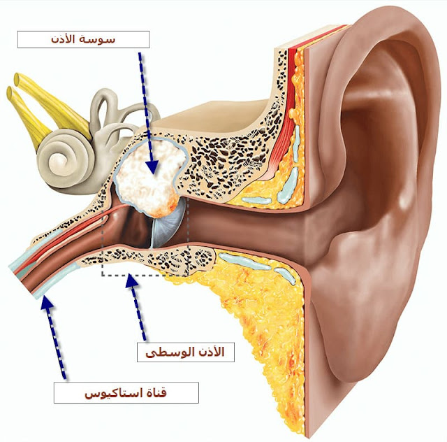 سوسة الأذن